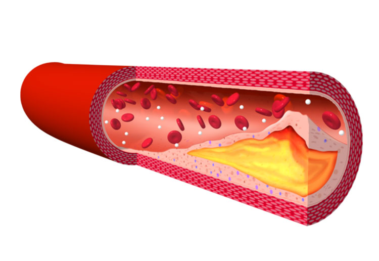 動脈硬化のイメージ写真
