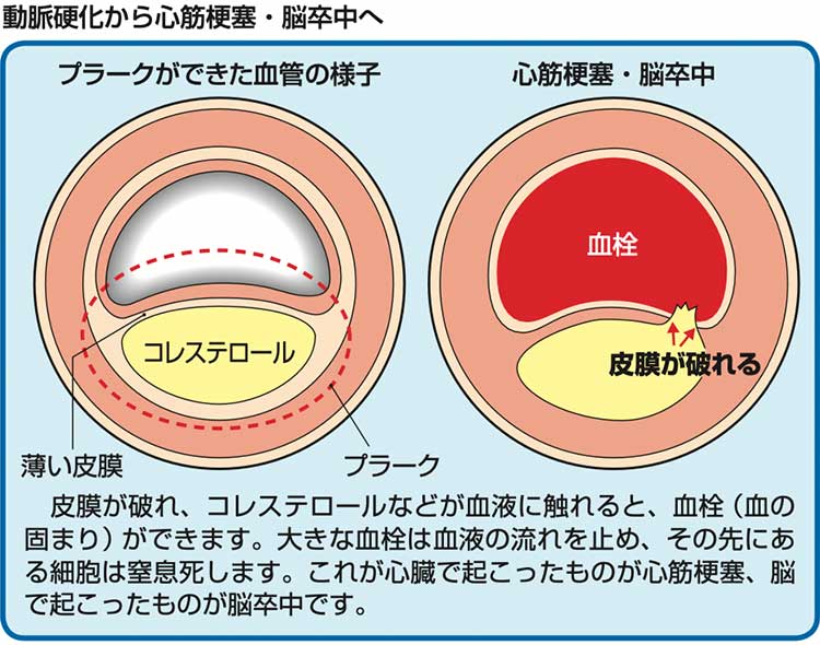 動脈硬化から心筋梗塞・脳卒中へ