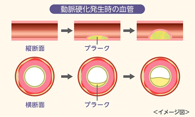 動脈硬化発生時の血管