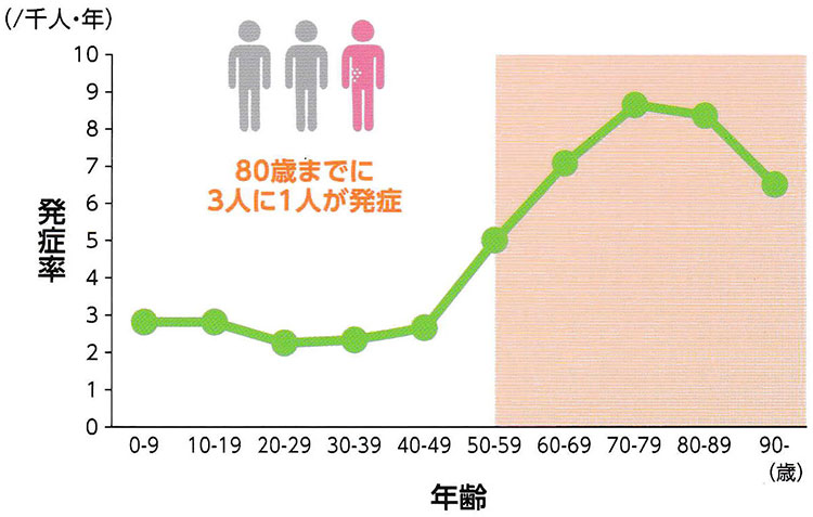 帯状疱疹の発症